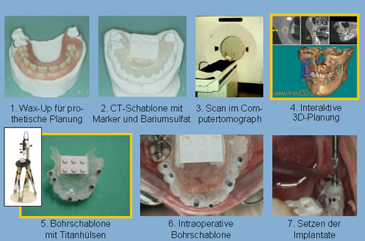 dreidimensionale Implantatplanung