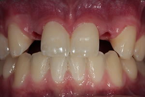 nichtanlage von Zähnen