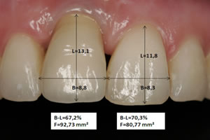 Kronenversorgung des Implantates regio 11