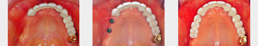 Fester Zahnersatz durch Implantate