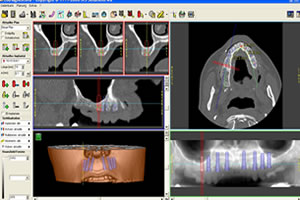 dreidimensionale Implantatplanung