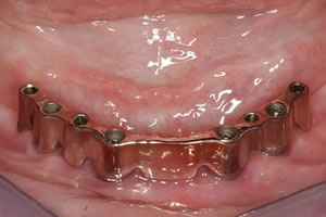 Zahnersatz auf 4 Implantaten