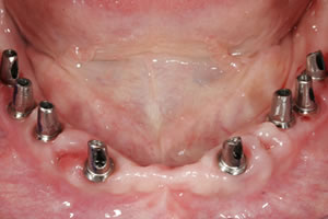 Zahnersatz auf 8 Implantaten